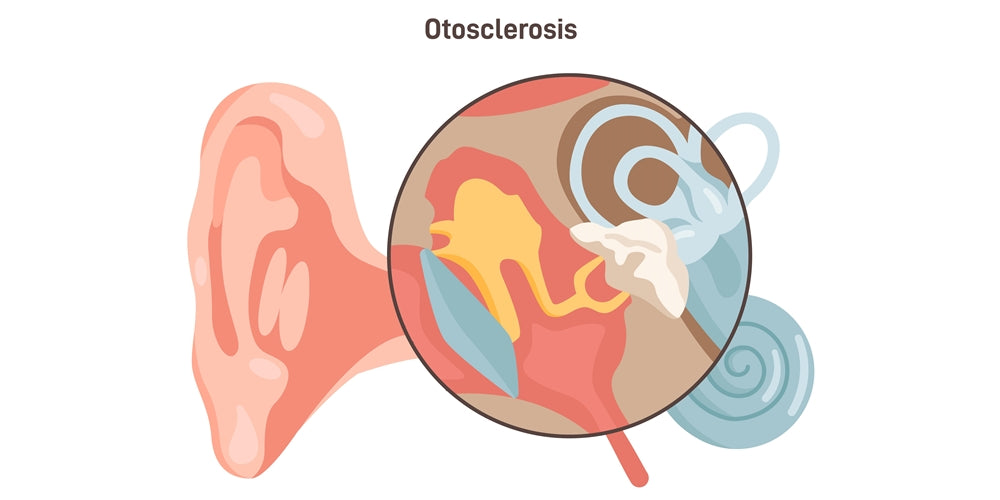 Какво е отосклероза?
